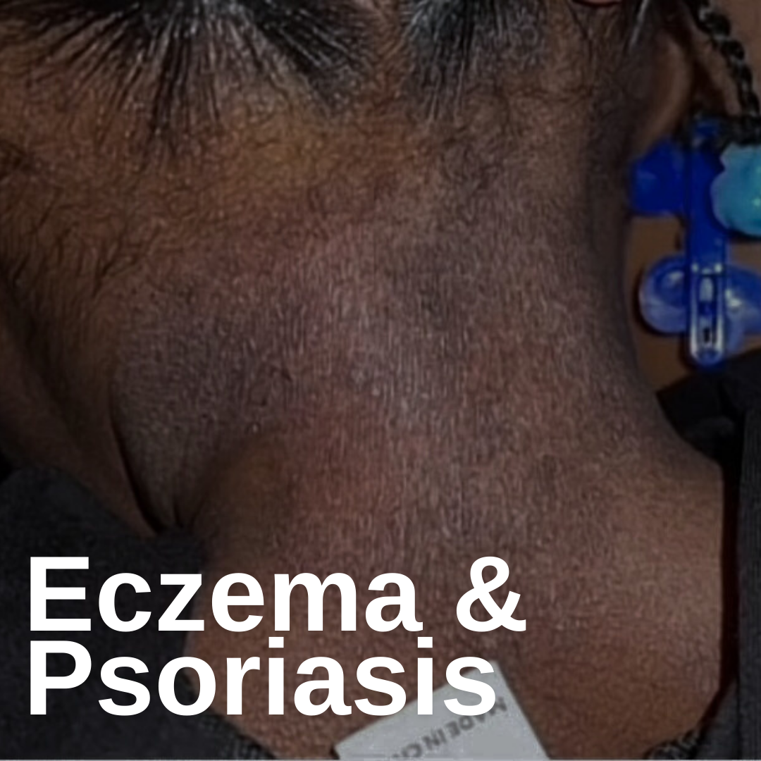 Eczema & Psoriasis