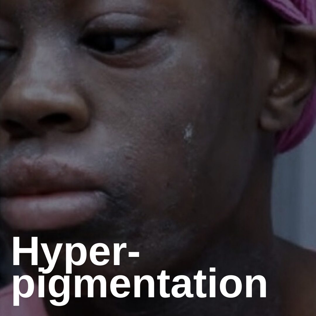 Hyperpigmentation