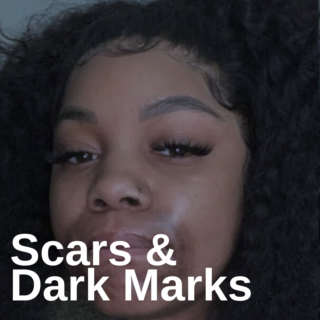 Dark Marks & Scars