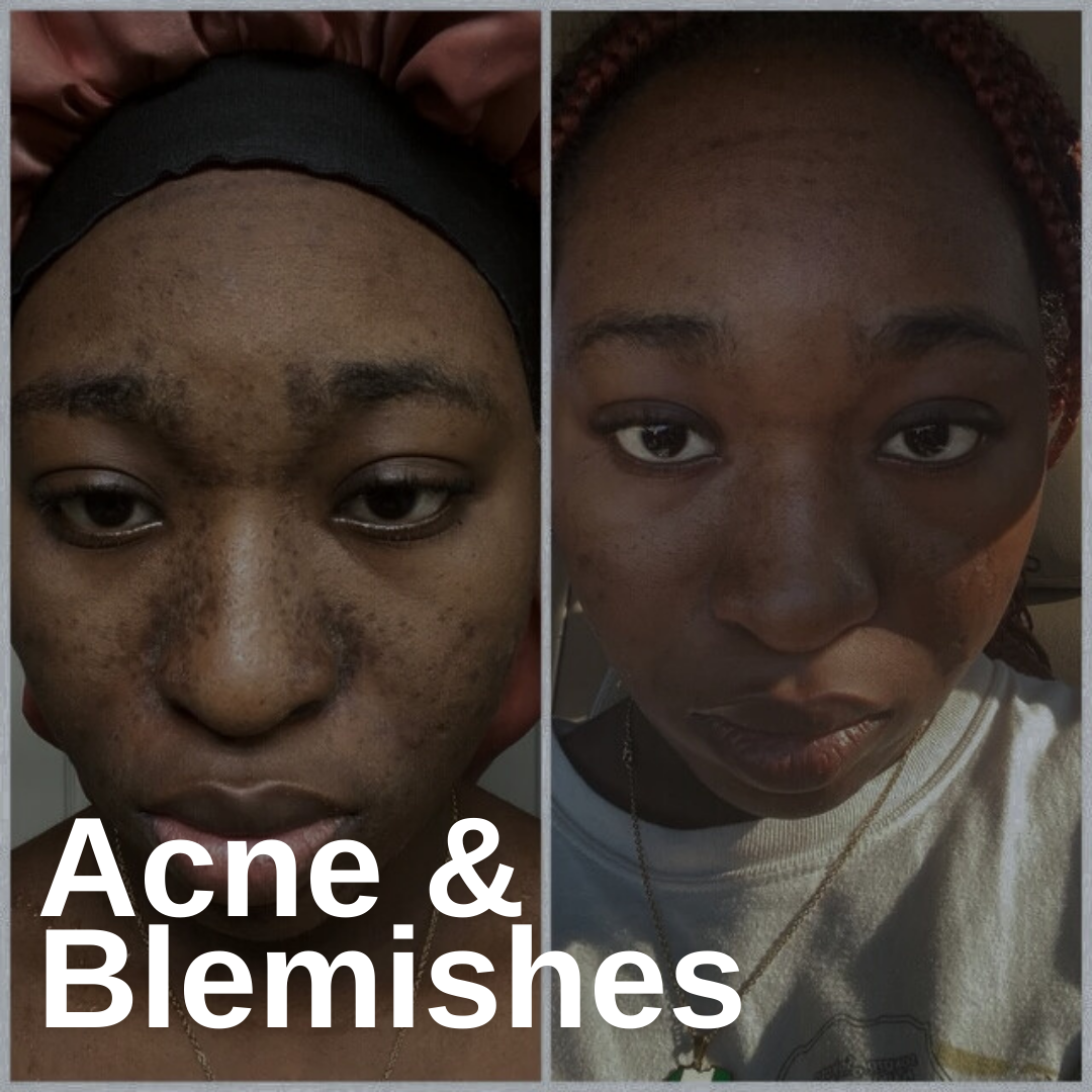 Acne & Blemishes